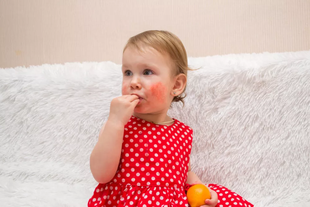 Is the Rash around Toddler’s mouth due to a Food Allergy